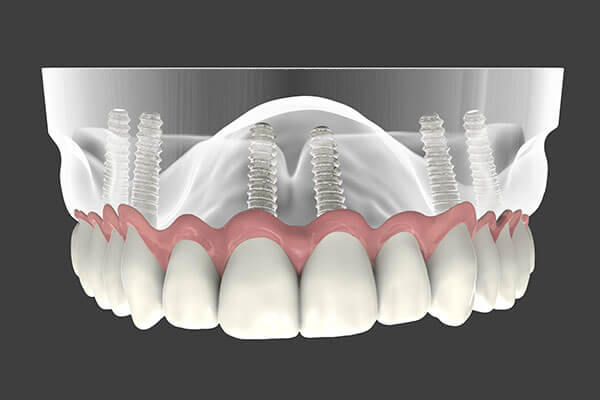 Full Arch with Only 4 Implants