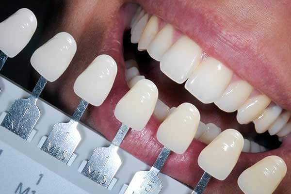 Composite Fillings